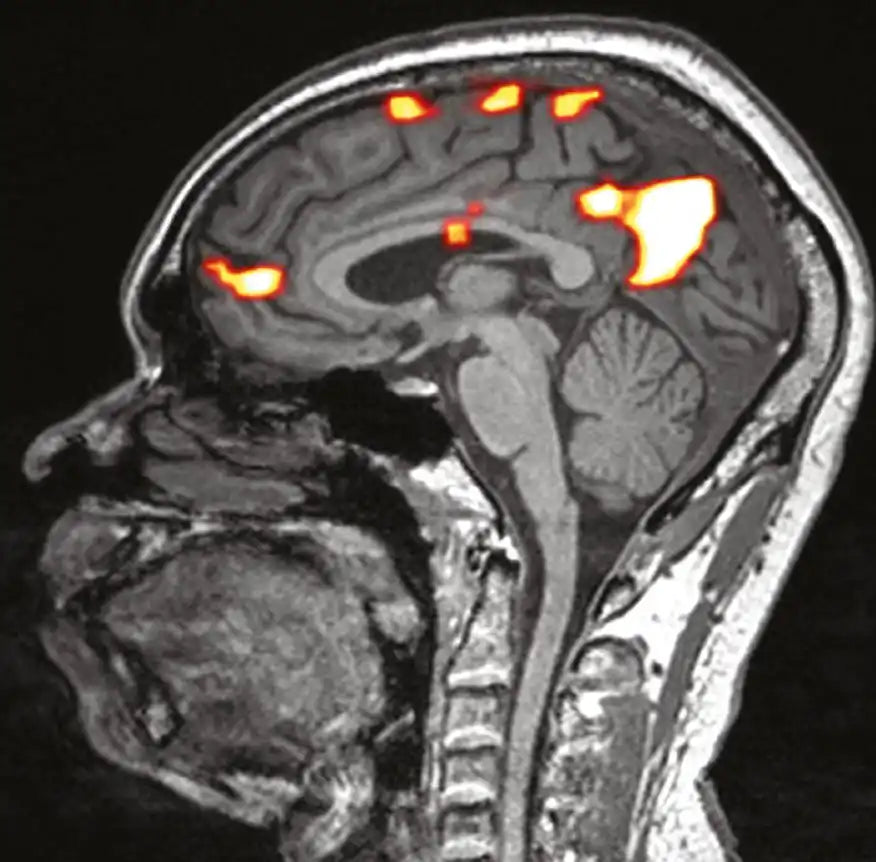 Functional brain MRI scan